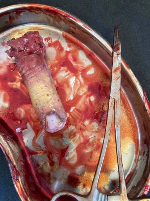 Other Surgical Tray With Silicone Severed Finger 3 Other Surgical Tray With Silicone Severed Finger - Image 3